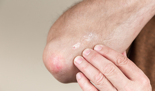 Aceite de coco para psoriasis Aceite de coco para psoriasis
